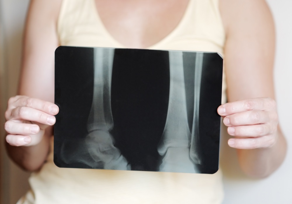 Can Bone Marrow Edema Be Cancer?