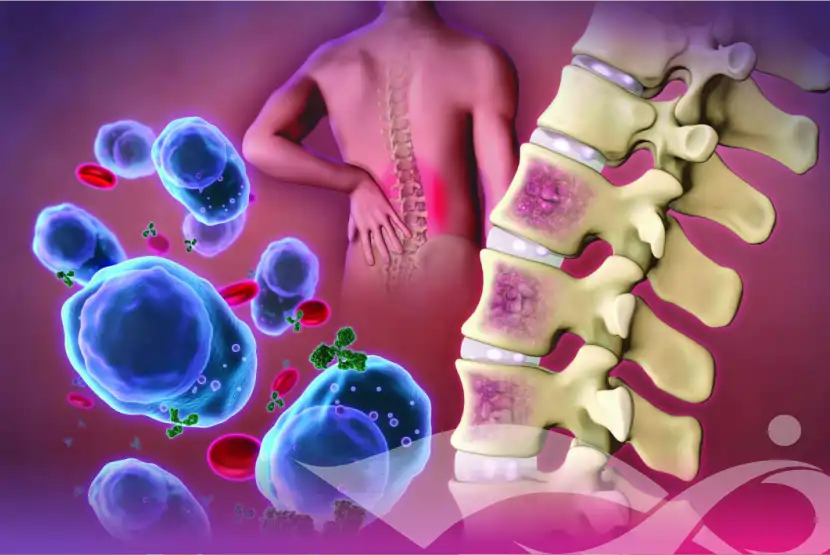 How Fast Does Multiple Myeloma Progress?