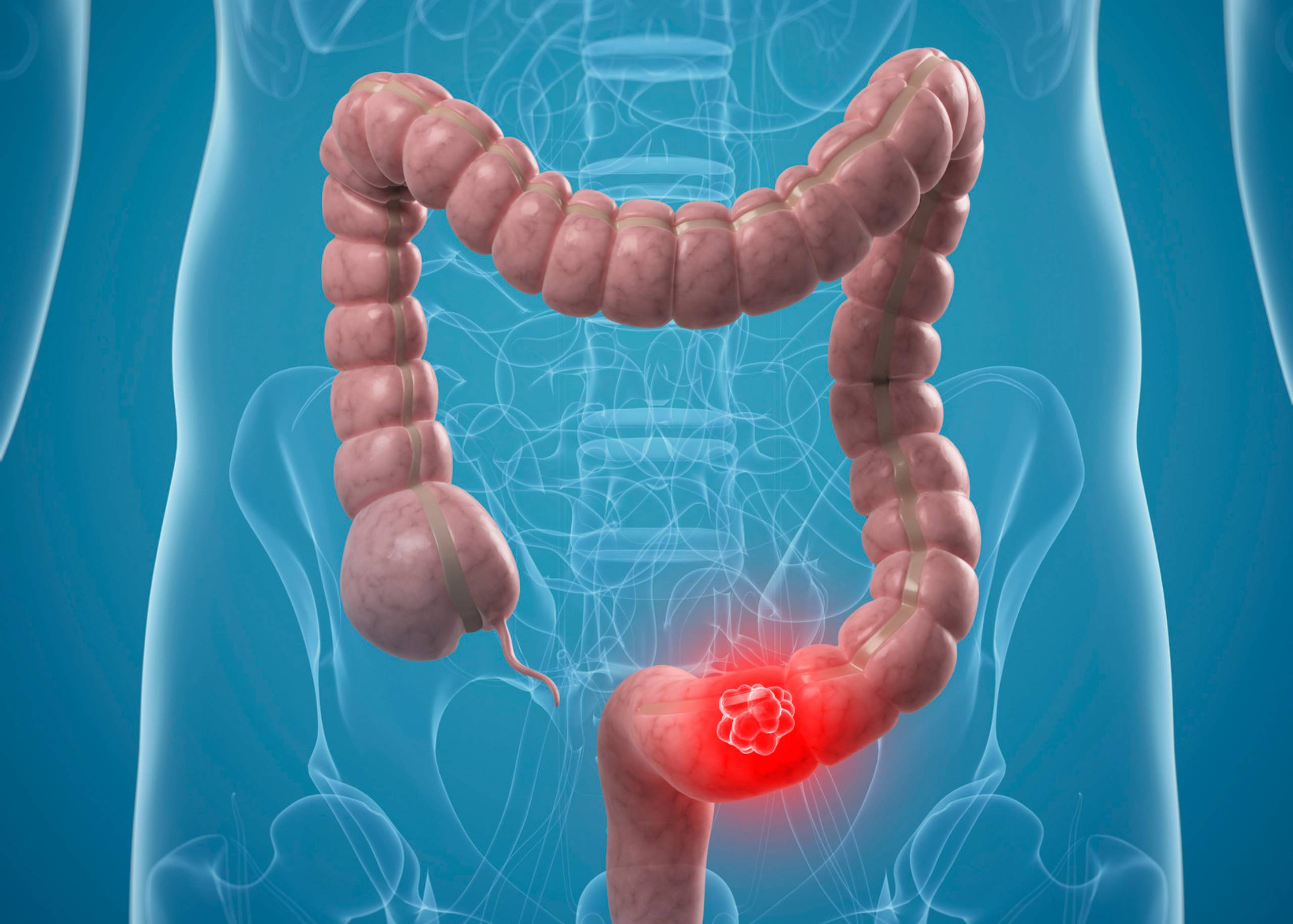 Is Stomach Cancer the Same as Colon Cancer?