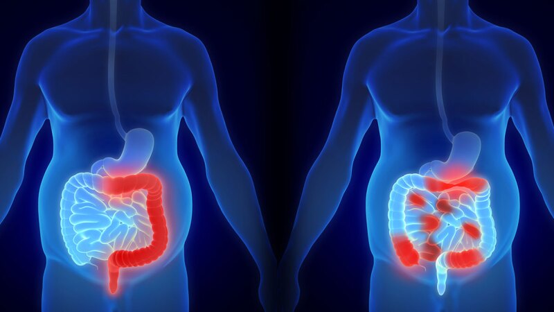 What Is the Prognosis for Stage 3 Colon Cancer?